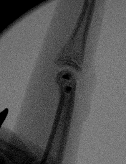 Finger Unicondylar Fracture ORIF Lateral